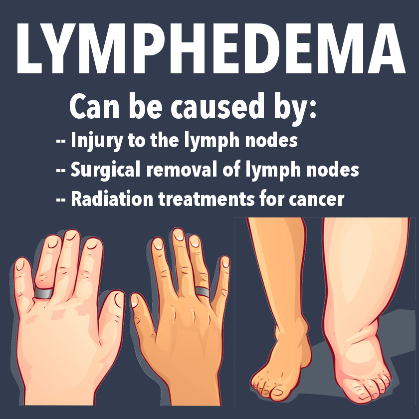 What Is Lymphedema Symptoms Causes Treatments